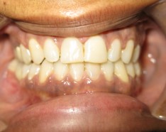 Apres Orthodontie Adulte Articulé Antérieur