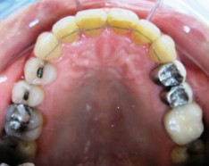 Bagues Dentaires Céramique Transparente : Appareil Dentaire Invisible