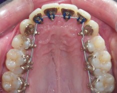 Orthodontie Linguale Incognito : Appareil Dentaire Invisible