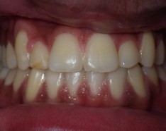 Patient Prognathe Apres Bagues Dentaires Céramique Transparente