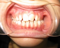Photo Avant Appareil Dentaire Quad Helix - Orthodontie Enfant