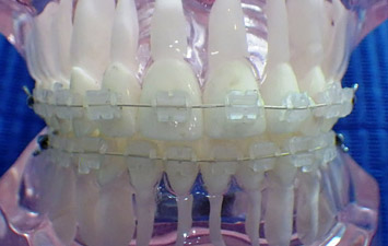 Appareil Dentaire Céramique : Bagues Transparentes