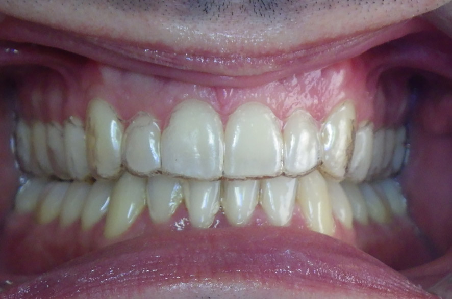 Traitement Invisalign Avec Gouttière Dentaire - Orthodontie Adulte
