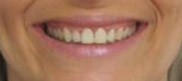 Dents Alignées Orthodontie Adulte