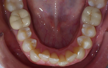 Traitement Orthodontique Pour Adulte