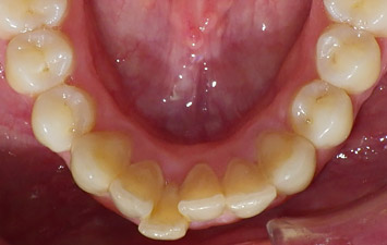 Encombrement Dentaire Orthodontie Enfant