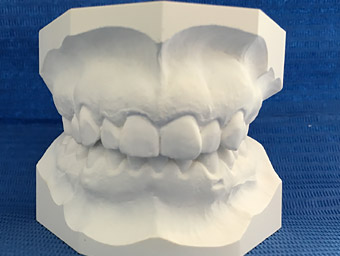 Empreintes Bilan Orthodontique