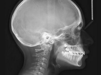 Traitement d'Orthodontie Radiographie