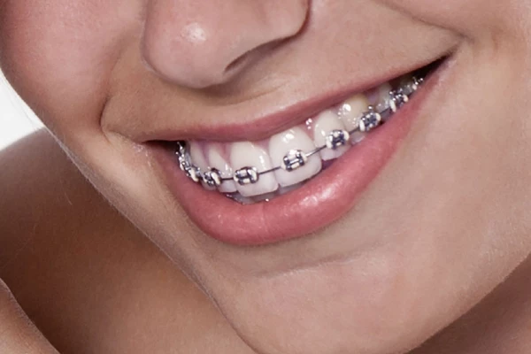 Réflexes Traitement d'Orthodontie & Appareil Dentaire