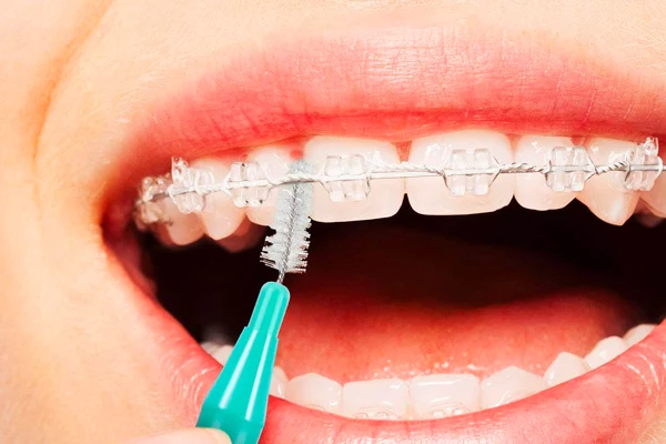 Conseils d’hygiène bucco-dentaire : le brossage des dents lors de votre traitement d'orthodontie