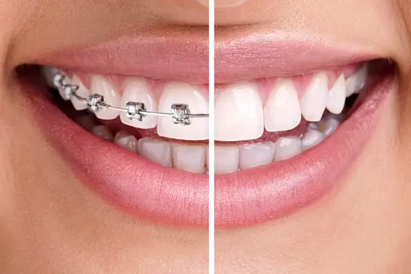 Traitement d'Orthodontie Enfant et Adulte