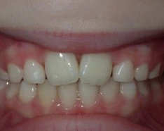 Après Traitement Orthodontie Enfant Endognathie Maxillaire