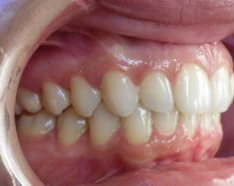 Après Traitement Invisalign : Gouttières Dentaires