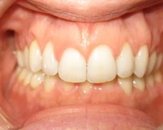 Traitement Invisalign par Gouttières Dentaires