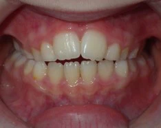 Avant Endognathie Maxillaire Orthodontie Enfant