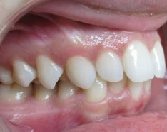 Traitement Invisalign Pour Encombrement Dentaire