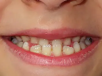 Orthodontie Enfant Paris