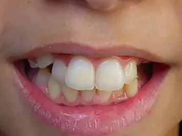 Traitement Orthodontie Enfant