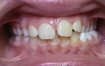 Endognathie et Endoalvéolie en Orthodontie Enfant