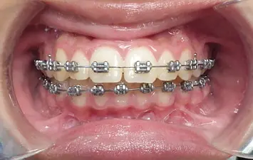 Appareil Dentaire Métallique : Bagues