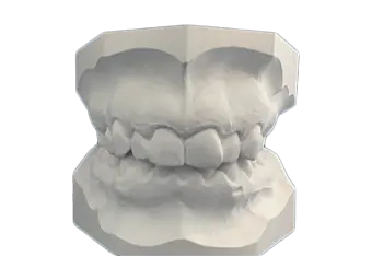 Empreintes Bilan Orthodontique