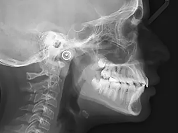 Traitement d'Orthodontie Radiographie